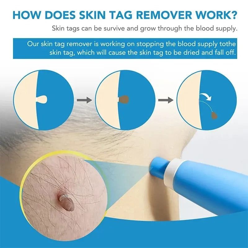 Skin Tag Removal Kit with Dual Heads and 40 Silicone Bands, Cleansing Wipes All Vera Mart
