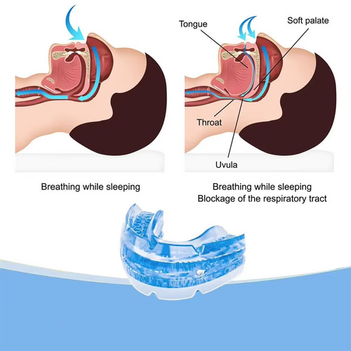 Anti-Snoring Oral Device with Multi-Position Jaw Adjustment and Ergonomic Design All Vera Mart