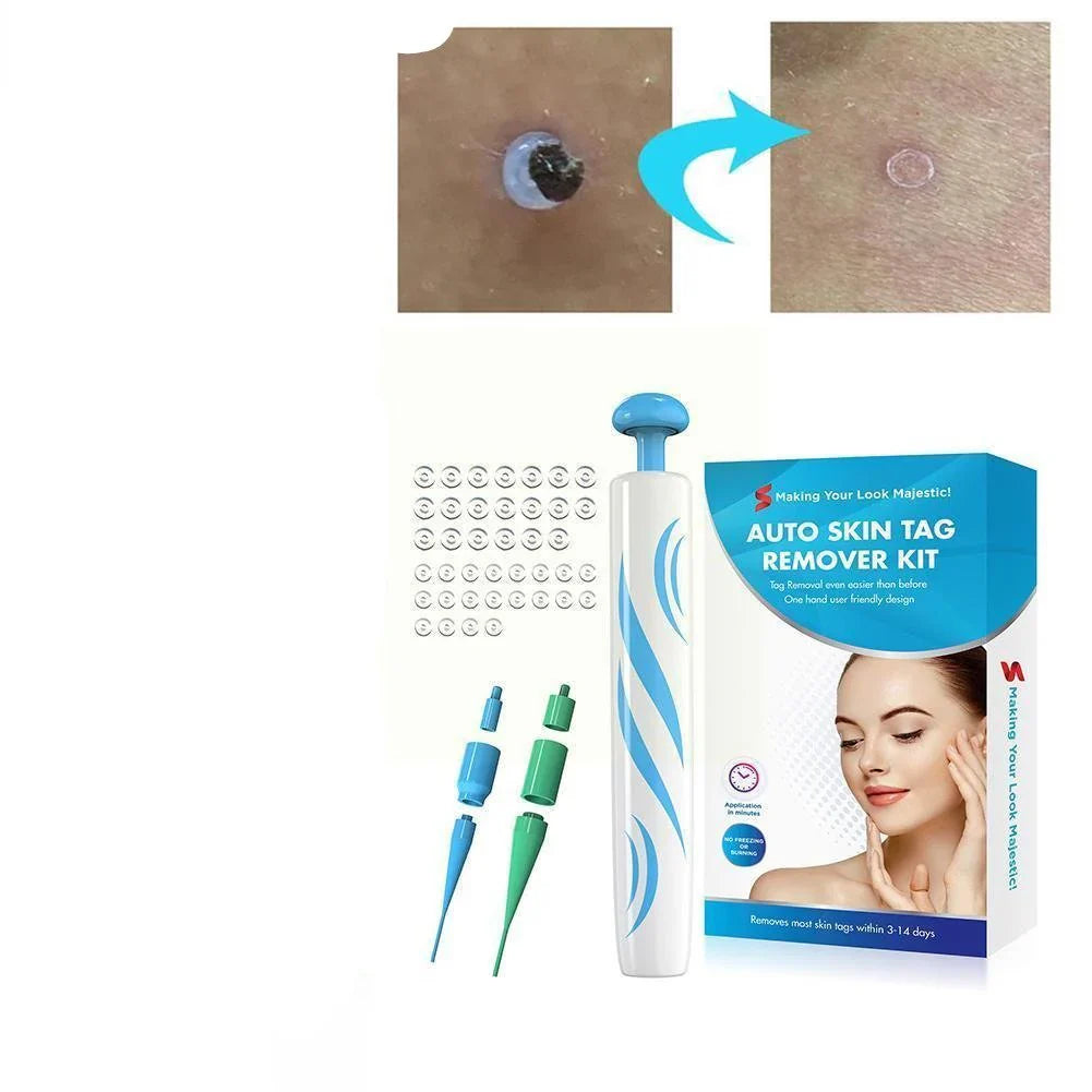 Skin Tag Removal Kit with Two Spring Sizes and Natural Drying Method All Vera Mart