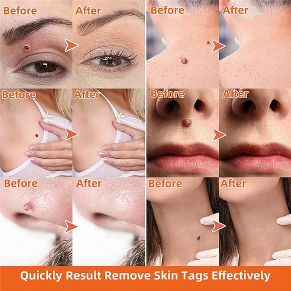 Skin Tag Removal Kit with Two Spring Sizes and Natural Drying Method All Vera Mart